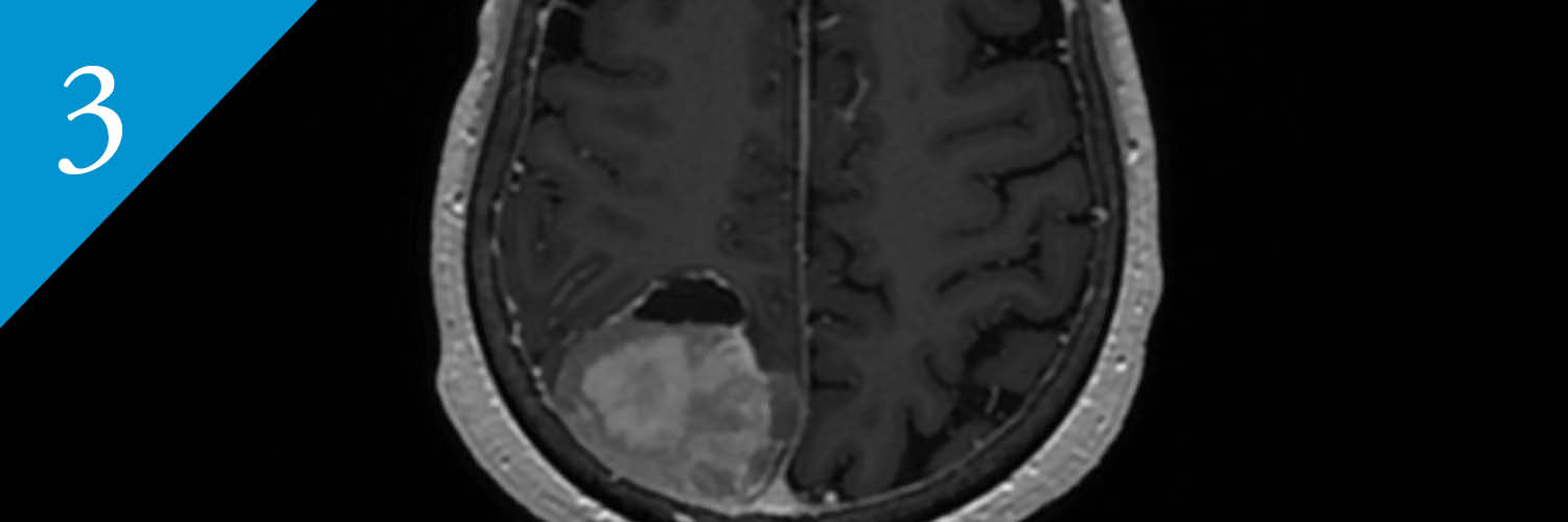 MRI showing a meningioma.