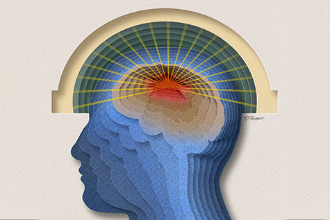 Illustration showing focused ultrasound beams targeting a brain tumor. Illustration by Ken Probst