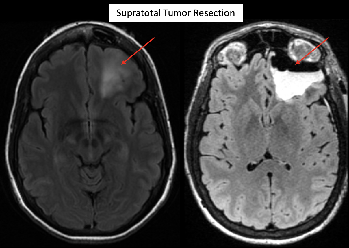 Three side-by-side MRIs of an astrocytoma