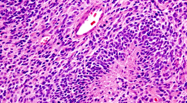Microscope image of glioblastoma taken by the UCSF Brain Tumor Research Center Tissue Biorepository and Histology Core.