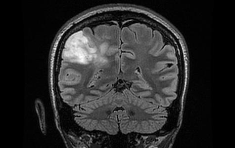 MRI scan of a young adult patient with oligodendroglioma
