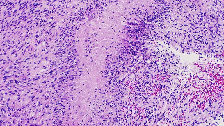 glioblastoma