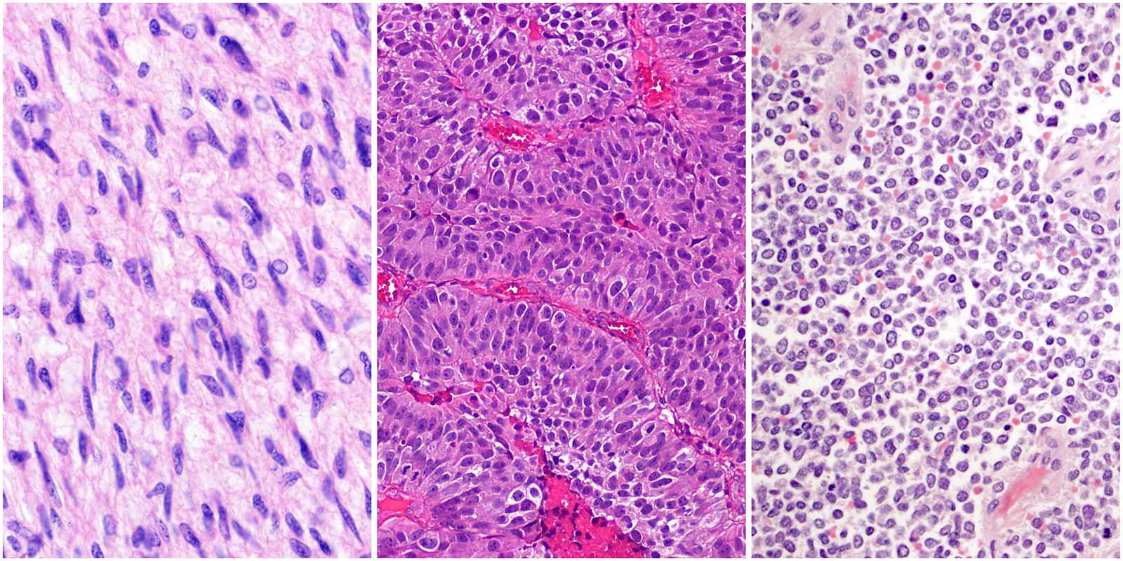 Histology images of glioblastoma, bladder cancer, and Ewing sarcoma