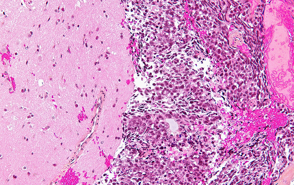 Brain metastasis. Credit: Nephron, Wikimedia (CC BY-SA 3.0)