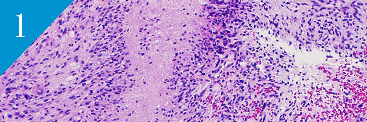 histology image of glioblastoma