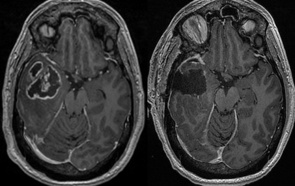 Pre- and post-op MRI of glioblastoma