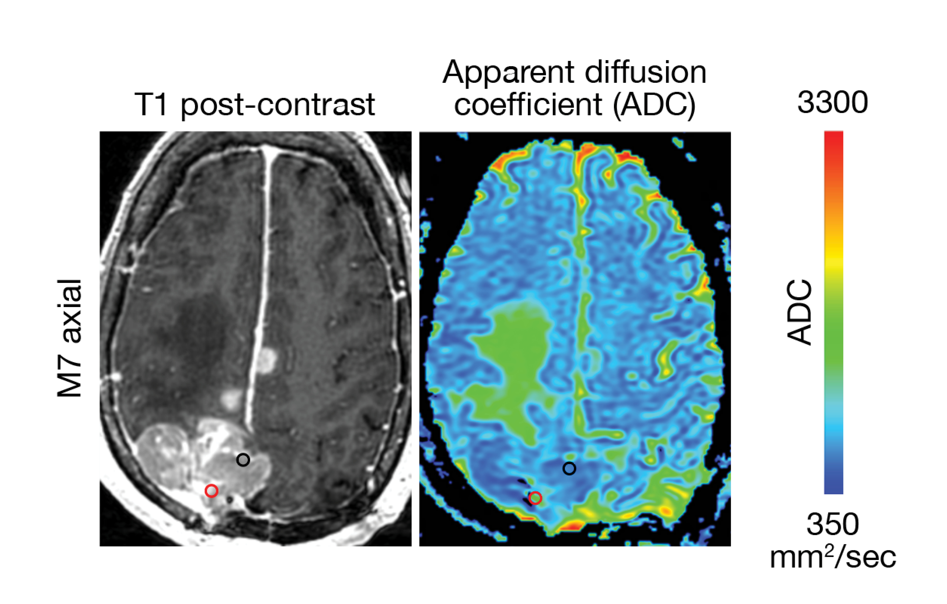 MRI and corresponding ADC levels in a meningioma