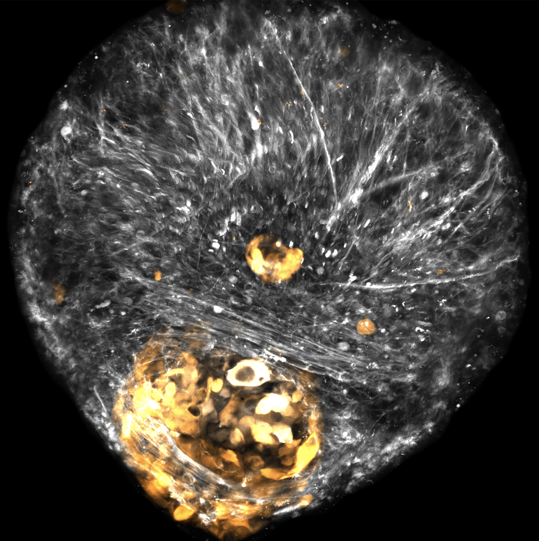 Meningioma cells (gold) invade a 3D cultured brain organoid (white) grown from human stem cells.