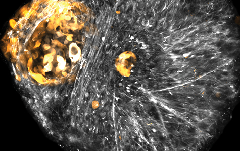 Meningioma cells invade a human cerebral organoid