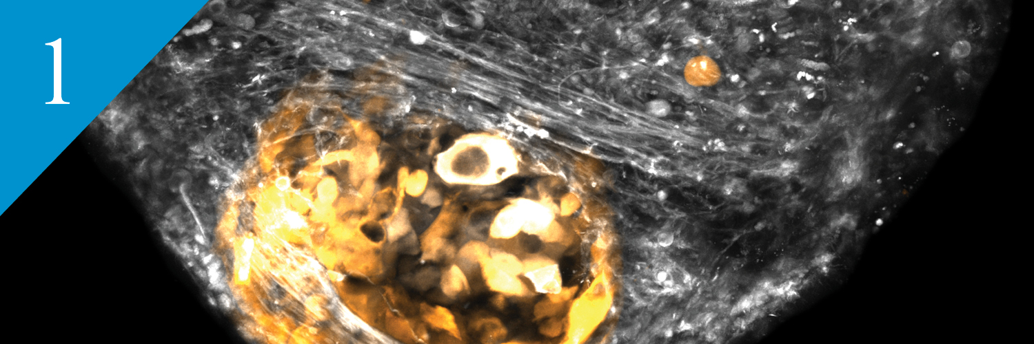 meningioma cells interact with brain organoid