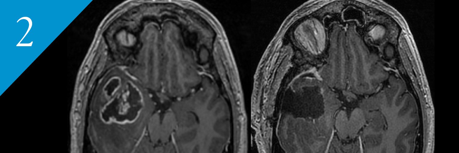 Preoperative MRI FLAIR of glioblastoma