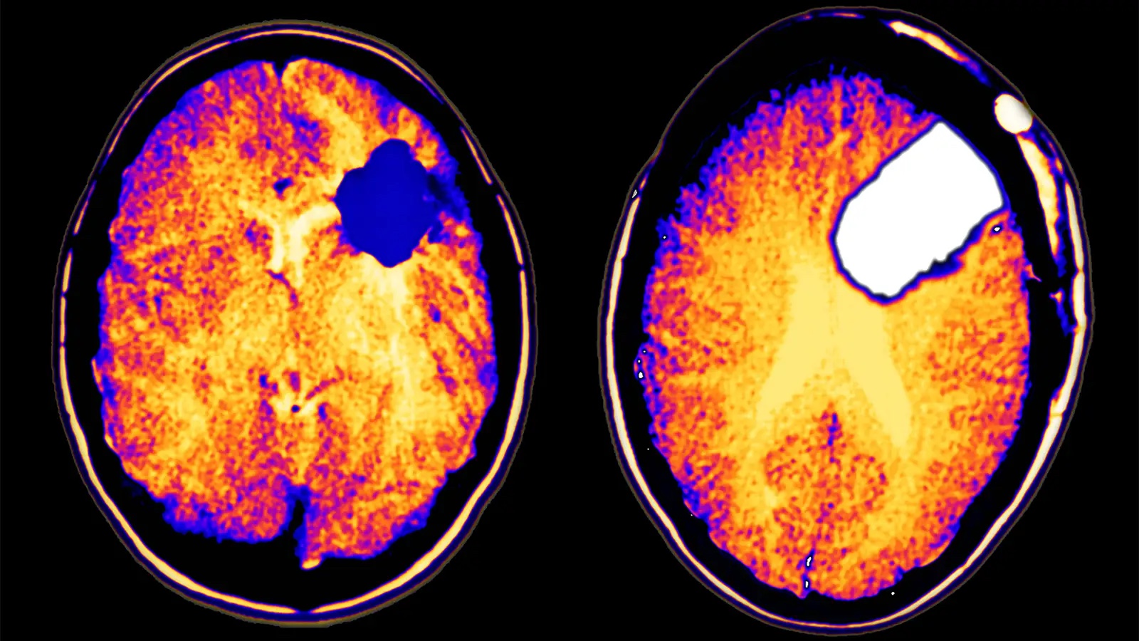 Side-by-side brain scans. A tumor is visible in the image on the left while the image on the right shows a white gap in the same location.