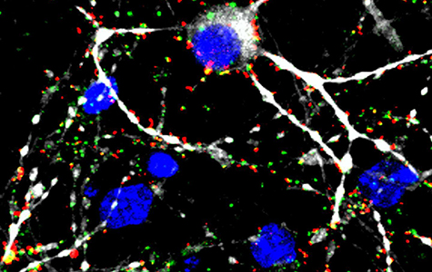 Human glioblastoma cells showing areas where new connections between cells are being formed at an accelerated rate. Image by Hervey-Jumper Lab.
