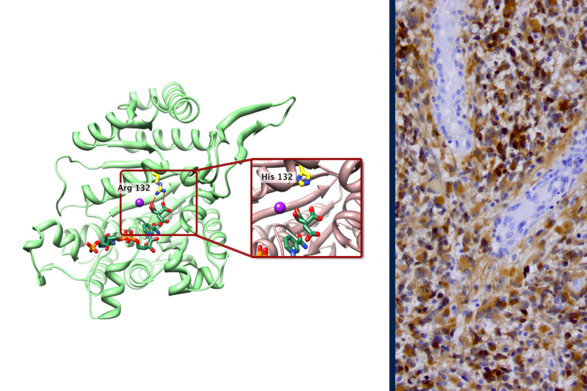 Two panel graphic showing the protein crystal structure of isocitrate dehydrogenase and a microscopy image of glioma tissue