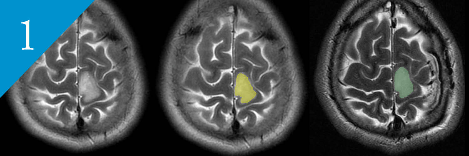 MRI scans showing how researchers calculated the extent of surgical resection.
