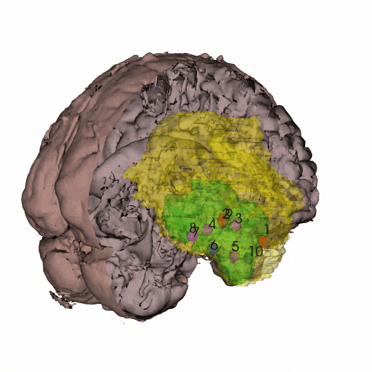 3D representation of individual patient's tumor showing where samples were taken for genomic and epigenomic analyses