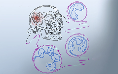 Illustration depicting that some neutrophils in glioblastoma migrate from the skull bone marrow to the tumor. Art by Ken Probst.