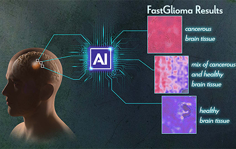 Illustration depicting how an AI tool called FastGlioma can quickly distinguish cancerous from healthy tissue during surgery to remove brain tumors. Credit: Donny Bliss/NIH, fastglioma.mlins.org.