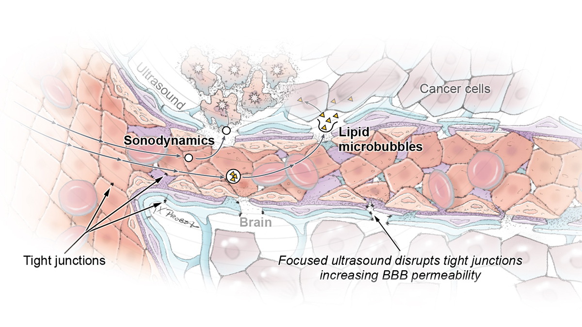 The combination of ultrasound waves and an injection of microbubbles into the blood disrupt the blood-brain barrier, allowing therapeutic molecules to penetrate the tumor. Illustration by Ken Probst