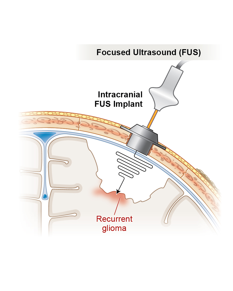 Illustration depicting an intracranial focused ultrasound implant. Art by Ken Probst.