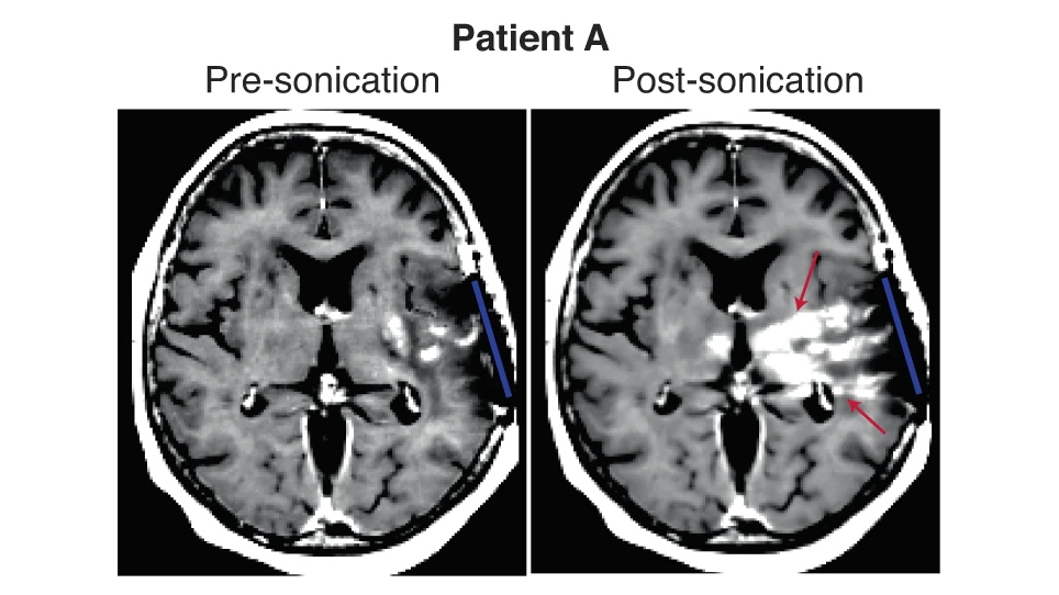 Two side-by-side MRI images showing that focused ultrasound (sonication) disrupts the blood-brain barrier.