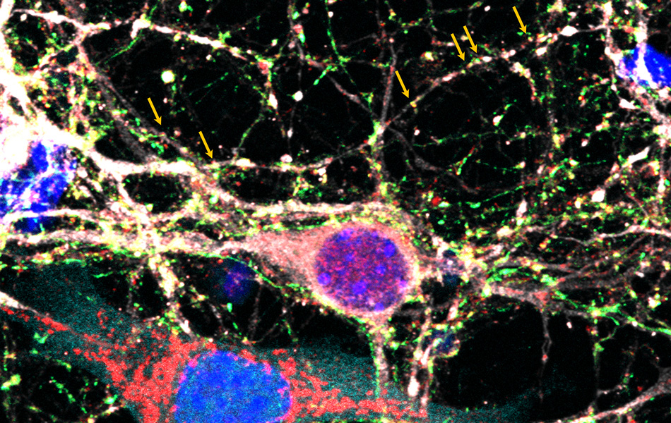 Microscopy image showing connections between glioblastoma cells and neurons. Image by Takahide Nejo, PhD.