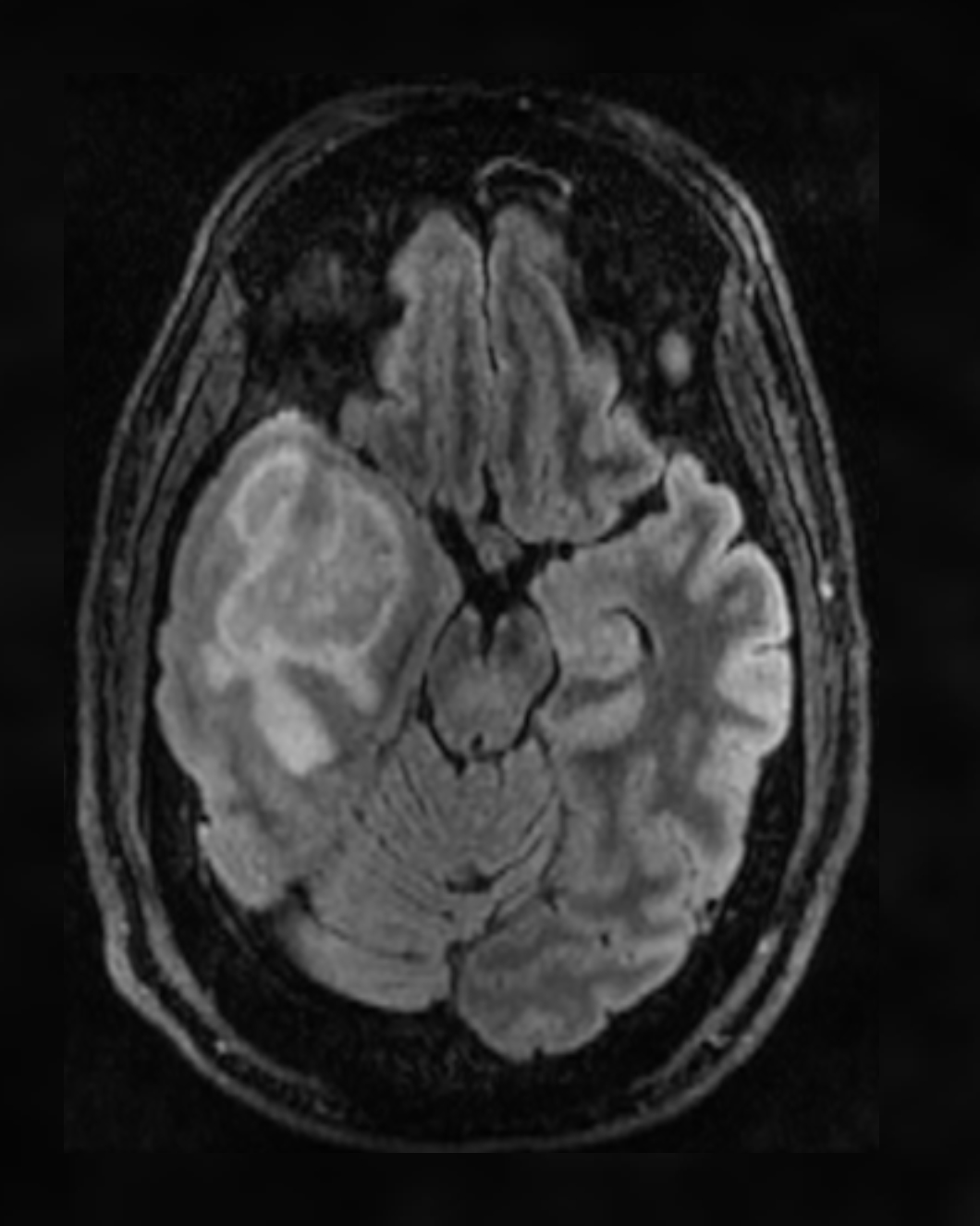 Glioblastoma MRI scan