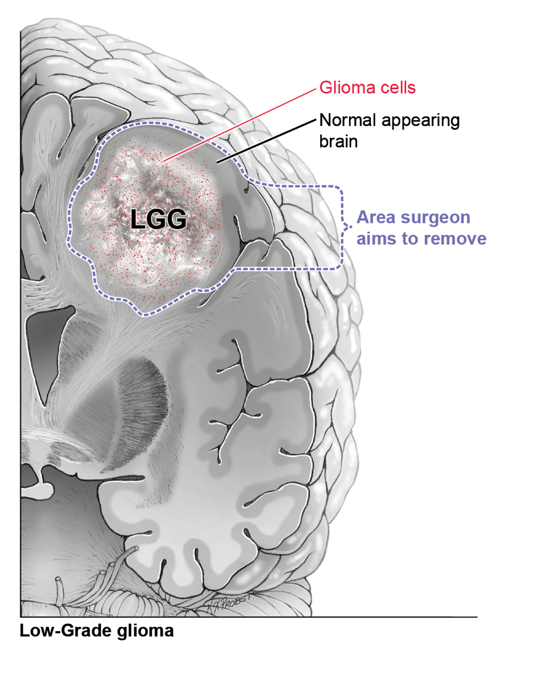 Illustration of a low-grade glioma in the brain, showing that a surgeon aims to remove some of the normal appearing tissue around the tumor. Art by Ken Probst.