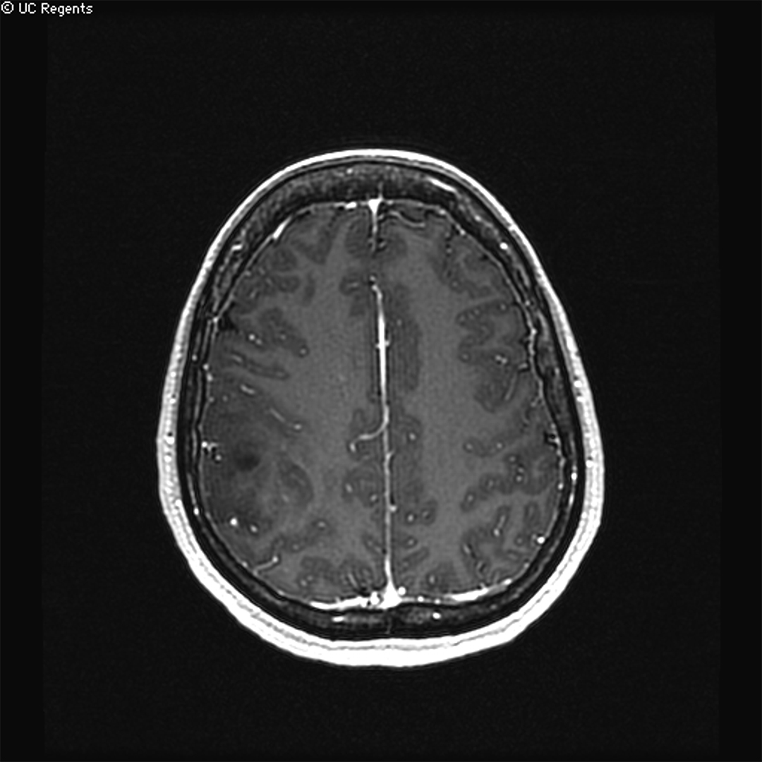 MRI showing a low-grade glioma