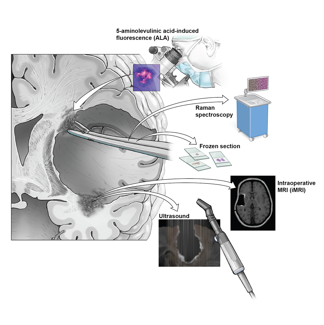 Illustration depicting the tools that surgeons use in the operating, including 5-aminolevulinic acid (ALA)-induced fluorescence, Raman spectroscopy, intraoperative MRI (iMRI), and ultrasound. 