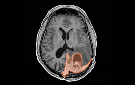 MRI scan showing a meningioma highlighted in orange.