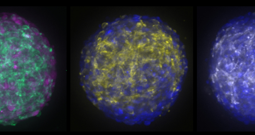 Meningioma organoids