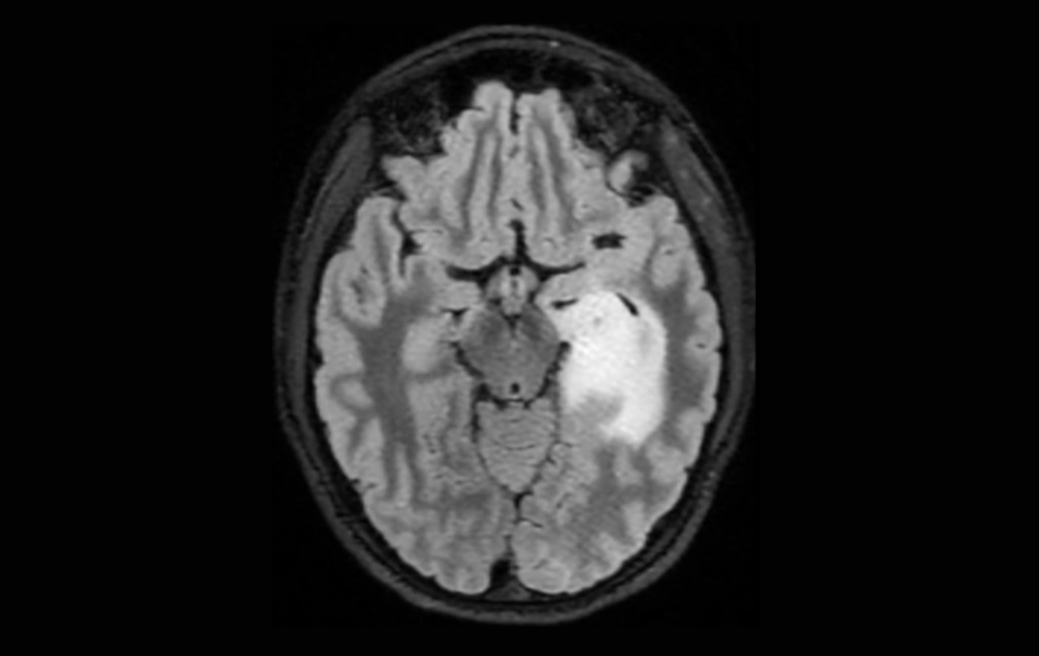 MRI scan of a low-grade glioma.