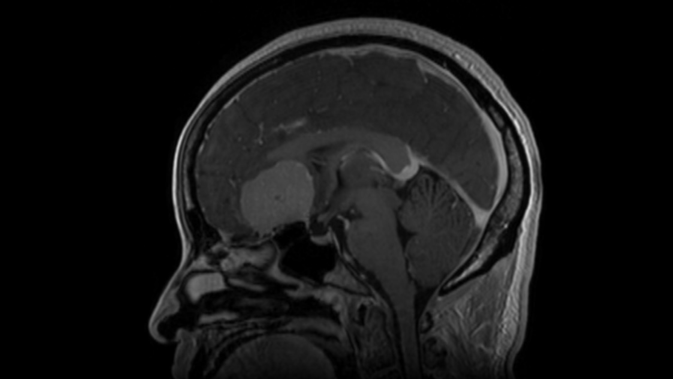 MRI scan showing a meningioma. 