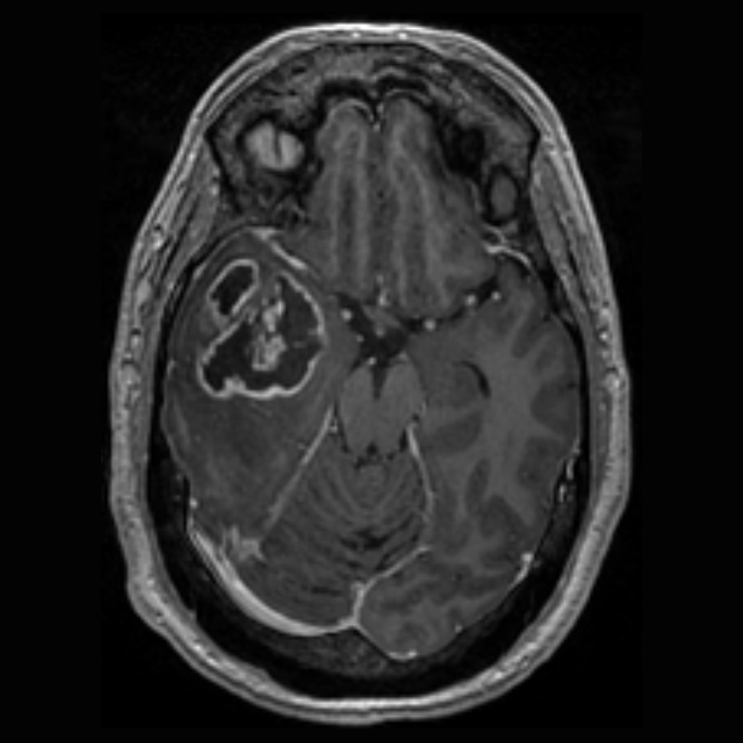 MRI scan showing a glioblastoma