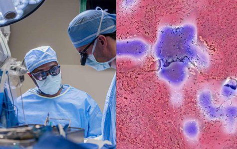 Two-panel image showing Shawn Hervey-Jumper, MD, during surgery (left) and a FastGlioma image of a tissue sample with the areas of tumor infiltration indicated in red (right). 