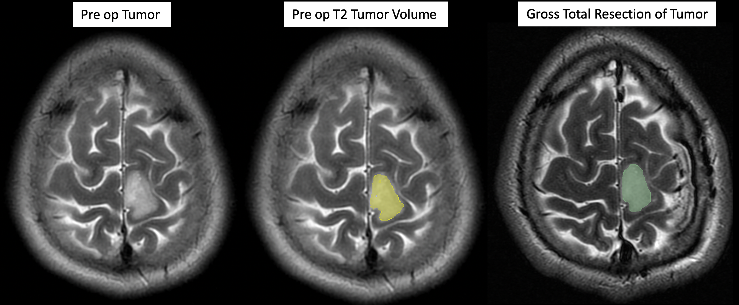 Three side-by-side MRIs of an astrocytoma