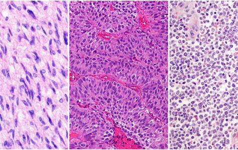histology images for glioblastoma, bladder cancer, and Ewing sarcoma