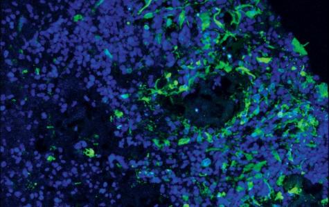 glioblastoma cells invade brain organoid