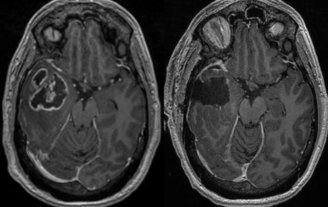 Pre- and post-op MRI of glioblastoma