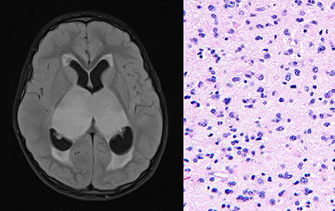 MRI (left) and histology (right) example of pediatric bithalamic glioma