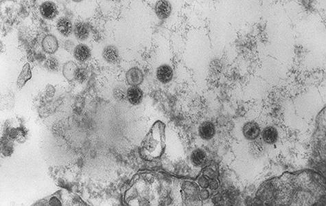 Transmission electron microscopic (TEM) image showing numerous Epstein-Barr virus (EBV) virions