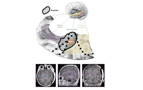 Postoperative MRI and reconstruction showing the resection margins with full removal of the lesion and Heschl’s gyrus.