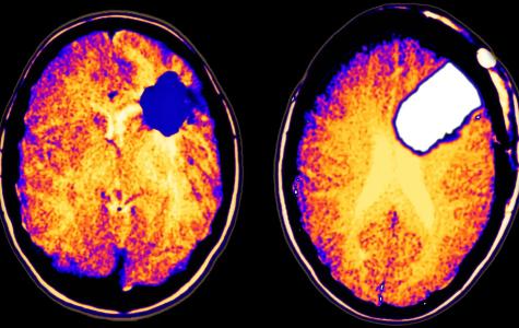 Side-by-side brain scans. A tumor is visible in the image on the left while the image on the right shows a white gap in the same location.