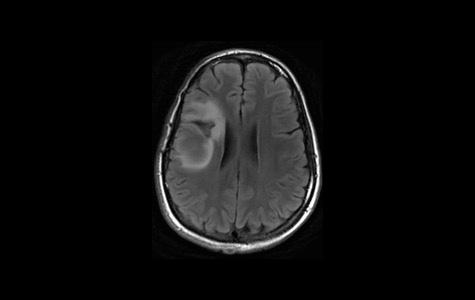 MRI image of a low-grade glioma. Image courtesy of Shawn Hervey-Jumper, MD.