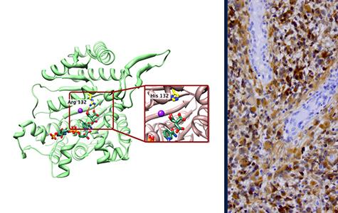 Two panel graphic showing the protein crystal structure of isocitrate dehydrogenase and a microscopy image of glioma tissue.