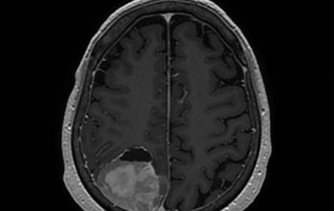 Meningioma MRI scan by Raleigh lab