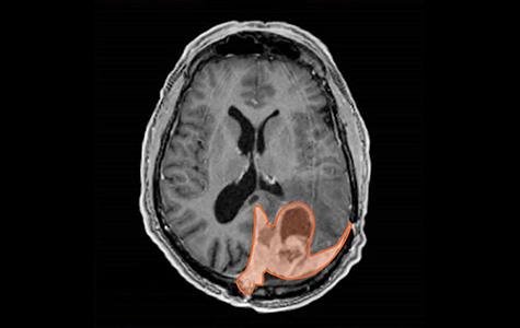 An imaging scan from a person with a meningioma (orange). Credit: National Cancer Institute/NCI-CONNECT.