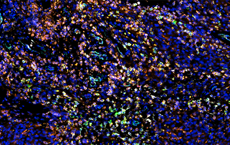 Multiplexed sequential immunofluorescence microscopy image of a primary meningioma.