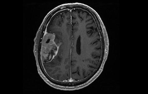 MRI scan showing a meningioma